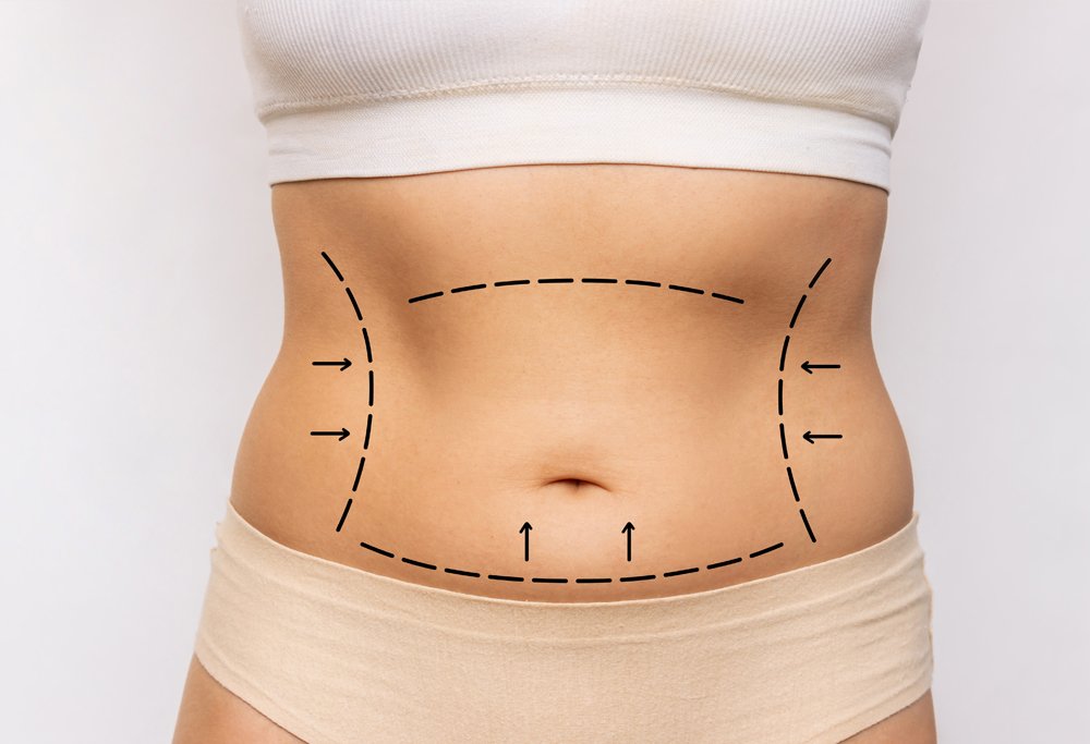 Liposuction